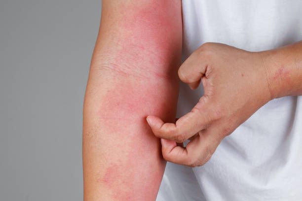 Preventing and Treating Heat Rash